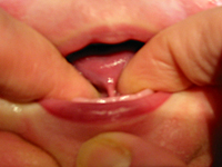 写真：舌小帯短縮症のAちゃん（1ヶ月児）