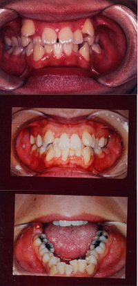 写真：悪い歯並び例